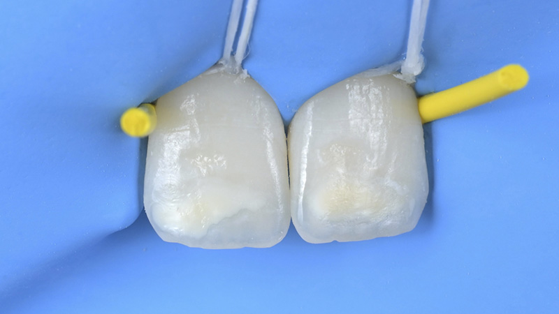 L’éclaircissement dentaire, traitement d’érosion, infiltration en profondeur