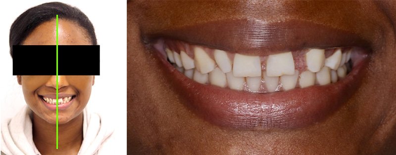 diastèmes, aligneurs, diagnostic