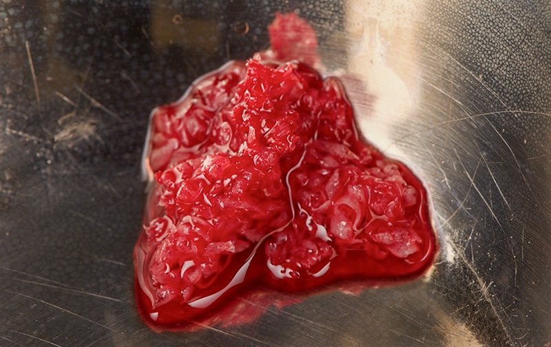 l’os autogène ainsi récupéré est mélangé à la xénogreffe