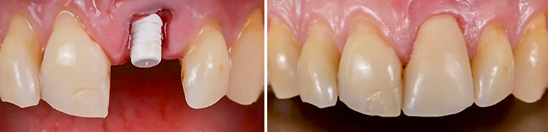 implant zircone, avant - après