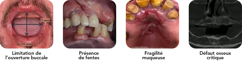 Maladies rares en bucco-dentaire