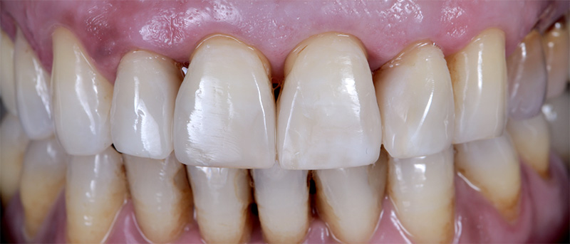 Amélioration de la complexité des restaurations esthétiques, résultat final 