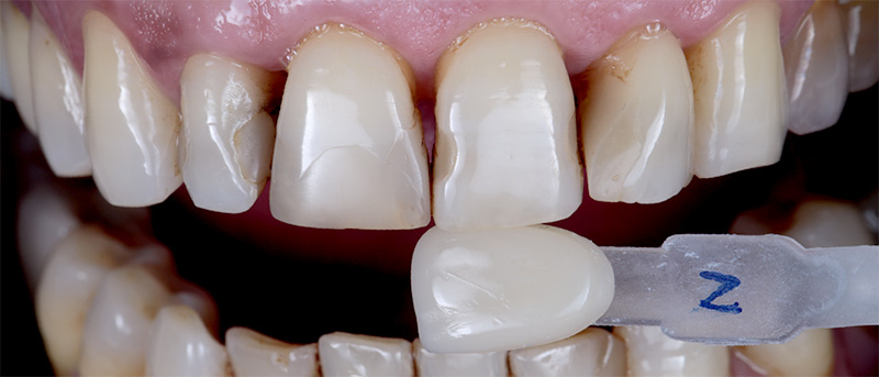 Amélioration de la complexité des restaurations esthétiques, préparation