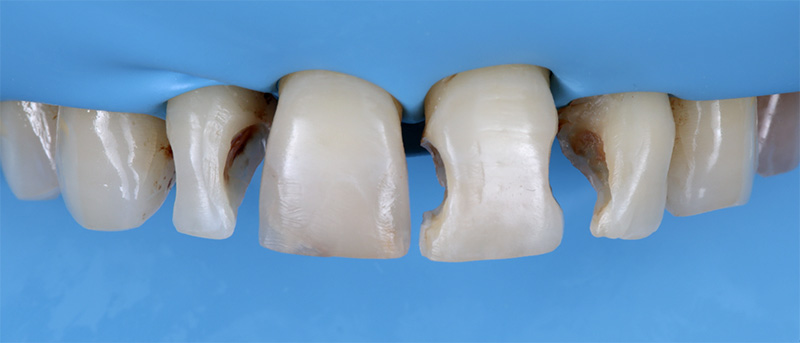 Amélioration de la complexité des restaurations esthétiques, préparation