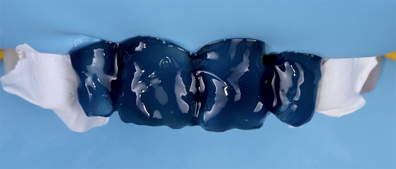 4. Les dents adjacentes sont protégées avec du ruban PTFE