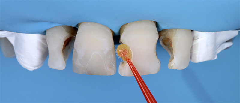 5. L’adhésif 3M™ Scotchbond™ Universal Plus est appliqué 