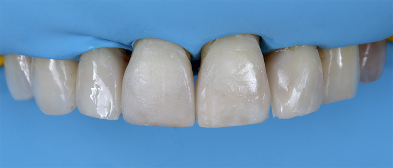 7. Résultat final avant finition et polissage
