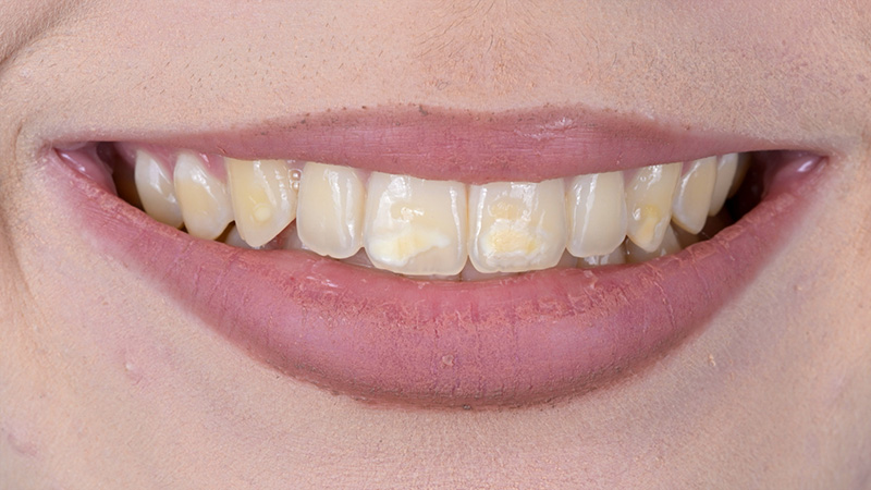 éclaircissement dentaire, situation initiale à l’échelle du sourire 