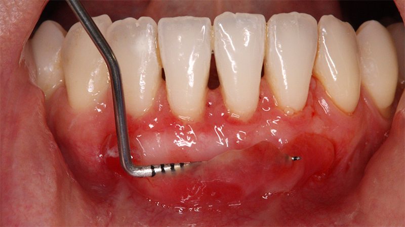 Chirurgie parodontale