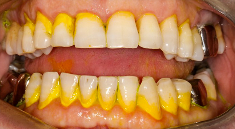 problèmes en parodontologie