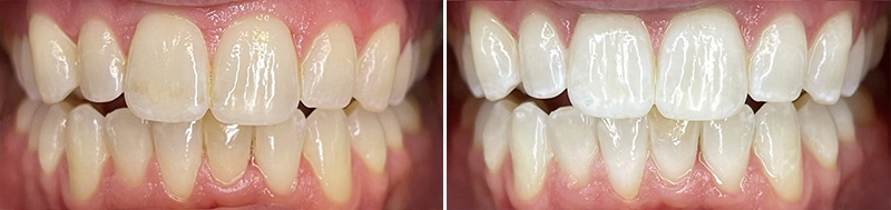 lumière bleue, avant et après