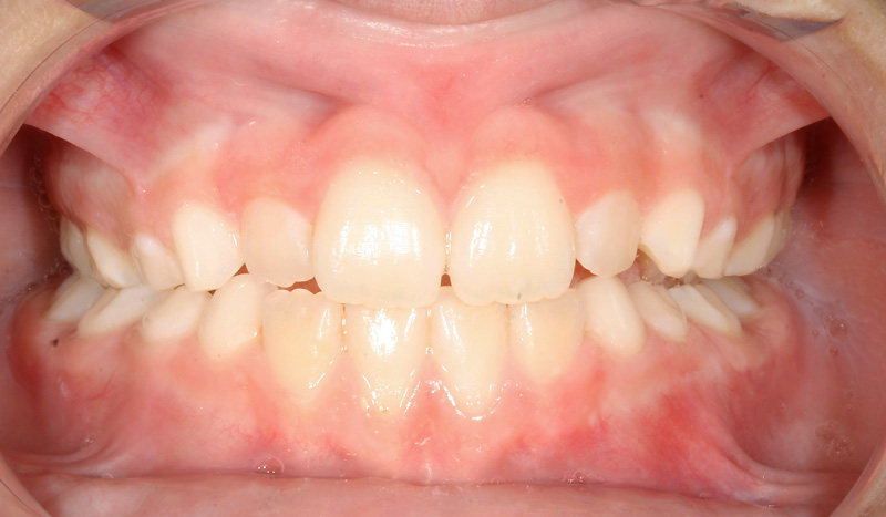 résultat après port d’un EFT sur un an