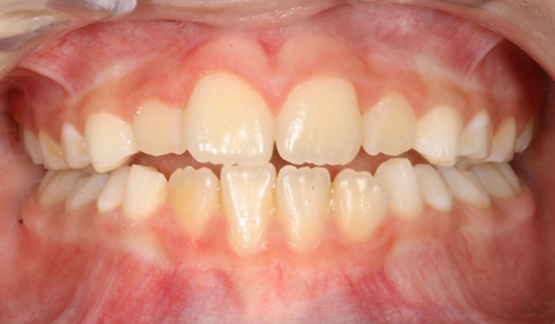 résultat après un an de port d’EF