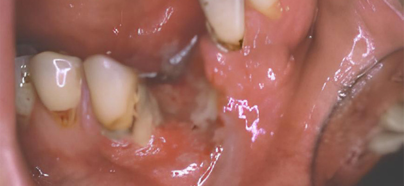 Cancer du plancher buccal antérieur