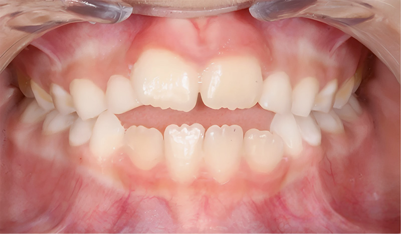 béance antérieure due à la présence de la langue 