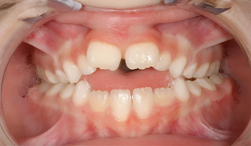 béance antérieure très marquée