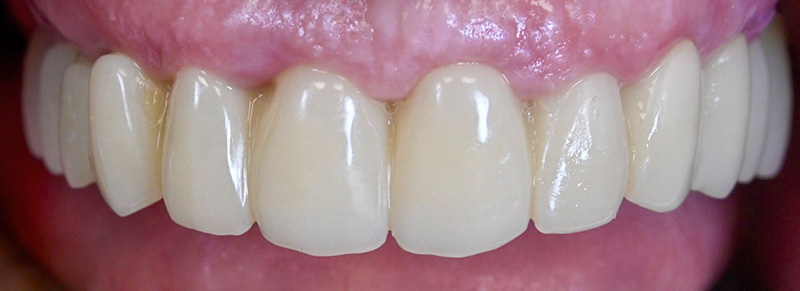 réhabilitation maxillaire, bridge PMMA transvissée à 8 jours