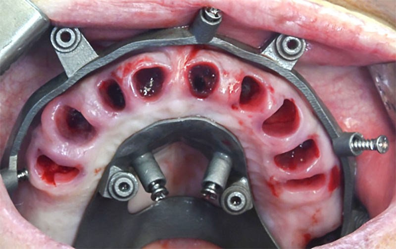 réhabilitation maxillaire, étape d’extractions