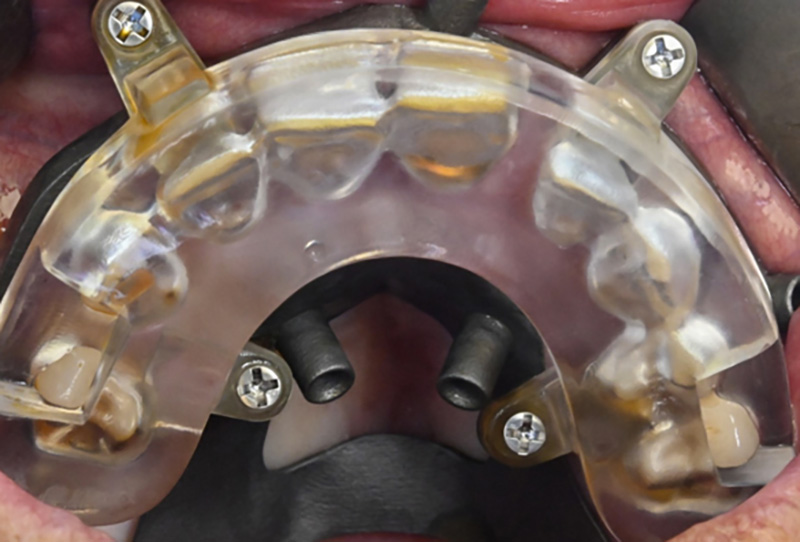 Positionnement du guide base à l’aide du guide de repositionnement occlusal