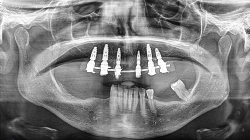 Réhabilitation maxillaire, panoramique de contrôle