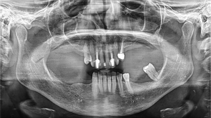 réhabilitation maxillaire, panoramique de départ