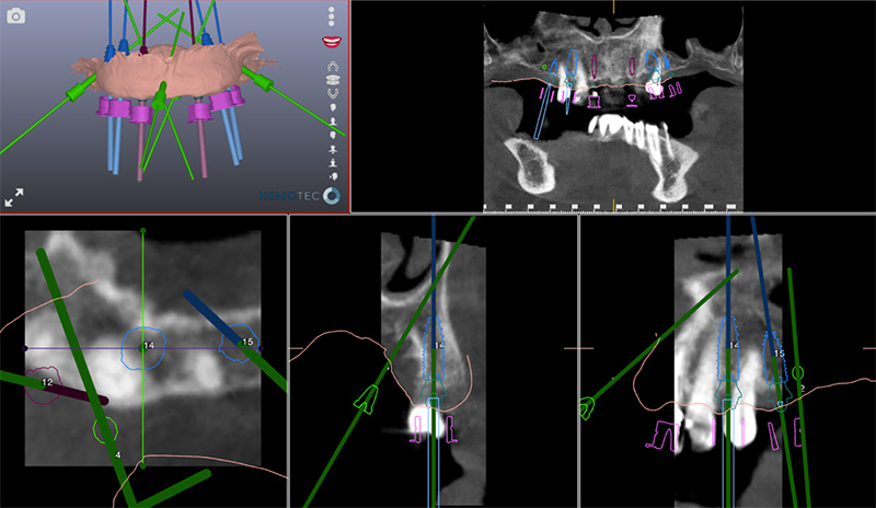 Planification implantaire 
