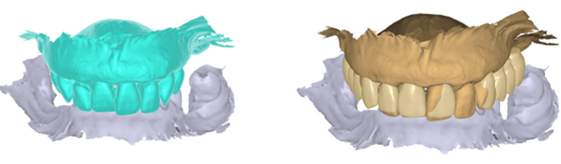 Wax-up prothétique, projet prothétique, avant