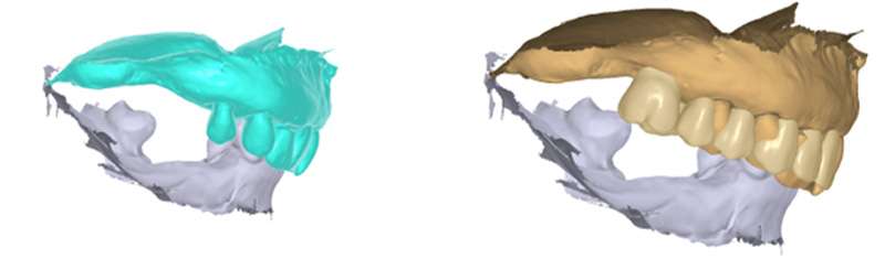 Wax-up prothétique, projet prothétique, droit