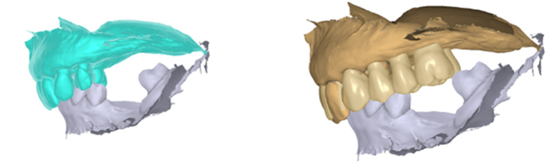 Wax-up prothétique, projet prothétique, gauche