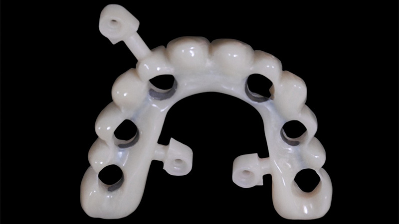 bridge transvissée PMMA avec armature usinée