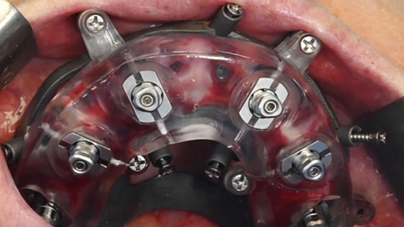 Guide chirurgical pour la pose des implants