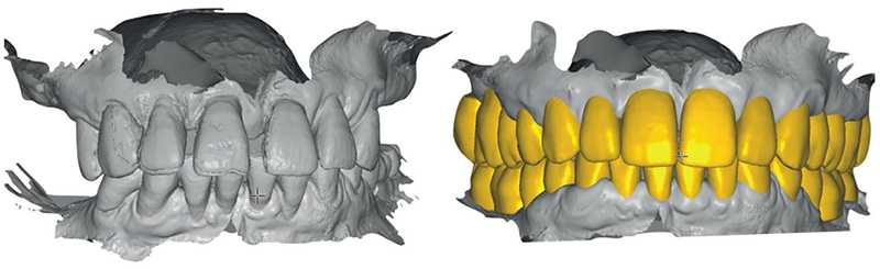 Digital Clone Technique en implantologie