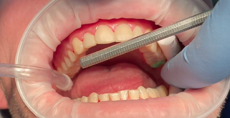 calage des 7 non waxées