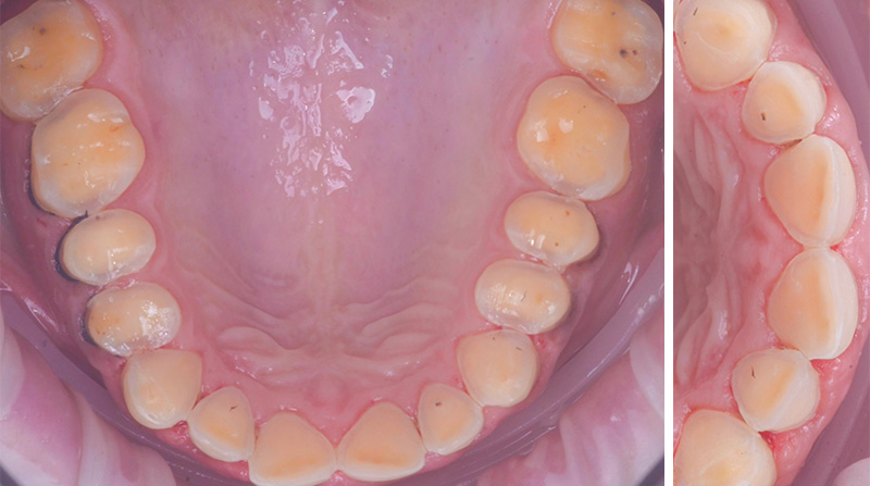 Préparation de l'arcade maxillaire dans le masque