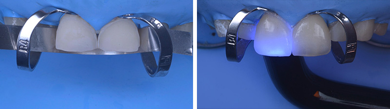 Collage des restaurations antérieures