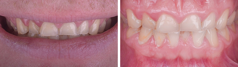 bruxomane - Etat initial