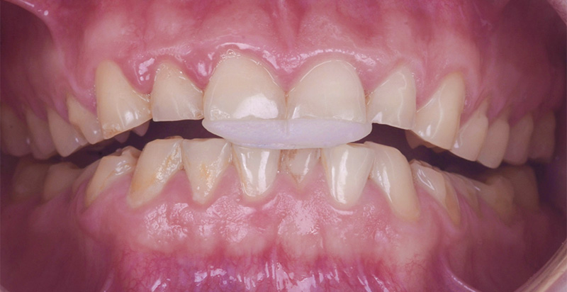 Jig en composite - évaluation de la future DVO