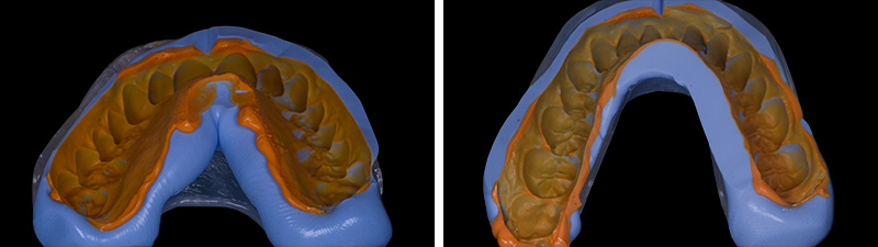 clés silicones des wax up