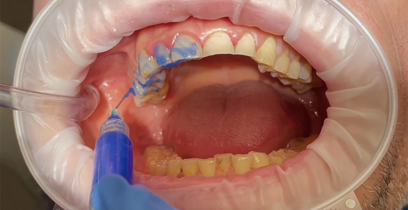 Mordançage grossier de l'arcade maxillaire