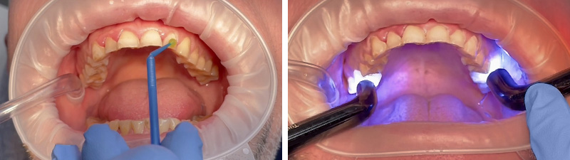 Adhésif universel polymérisé