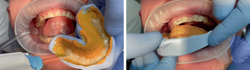 masque en résine bisacrylique