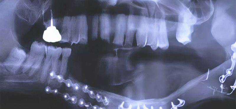 Reconstruction mandibulaire