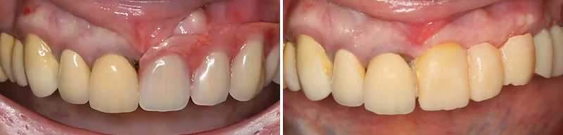 implantologie numérique, Cas 1, avant et après