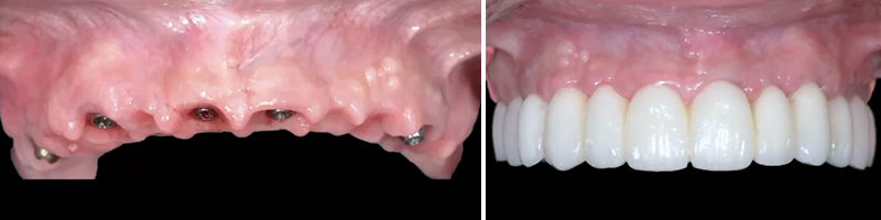 implantologie, réel et virtuel