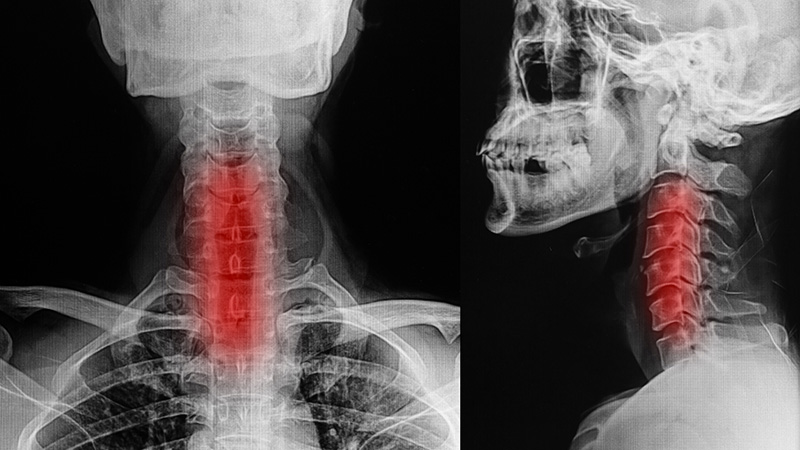Radiographie colonne vertébrale, mauvaise posture