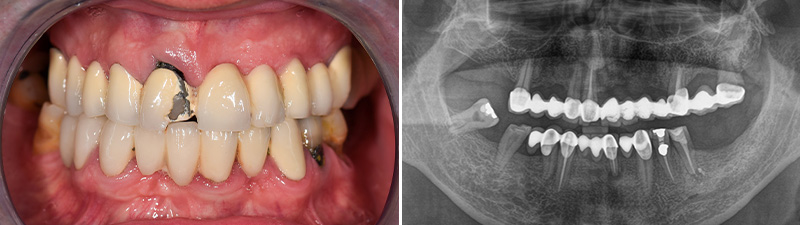 Photographie intraorale préopératoire