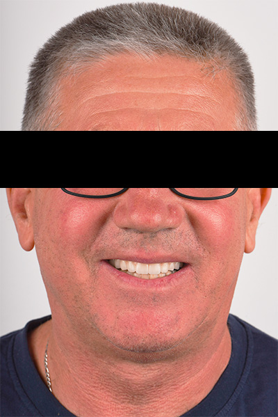 Patient après All-on-4