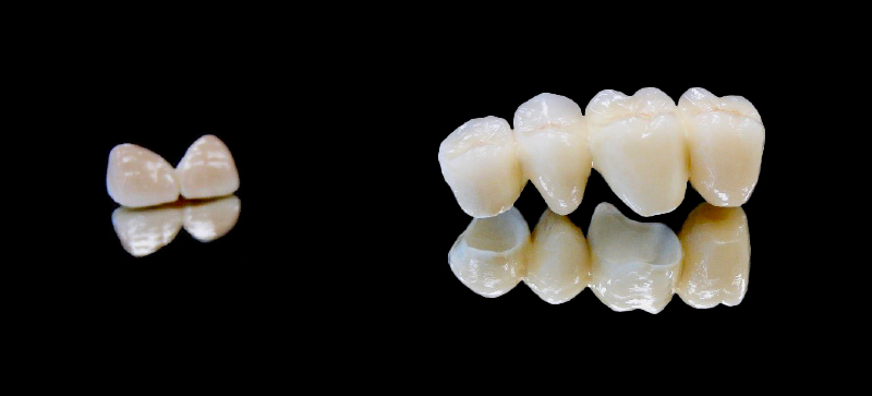 prothèse zircone et Emax