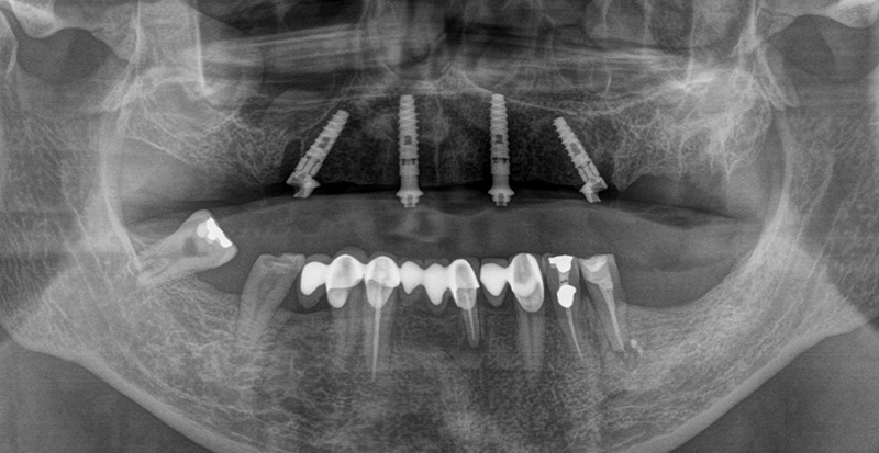 radiographie panoramique de contrôle