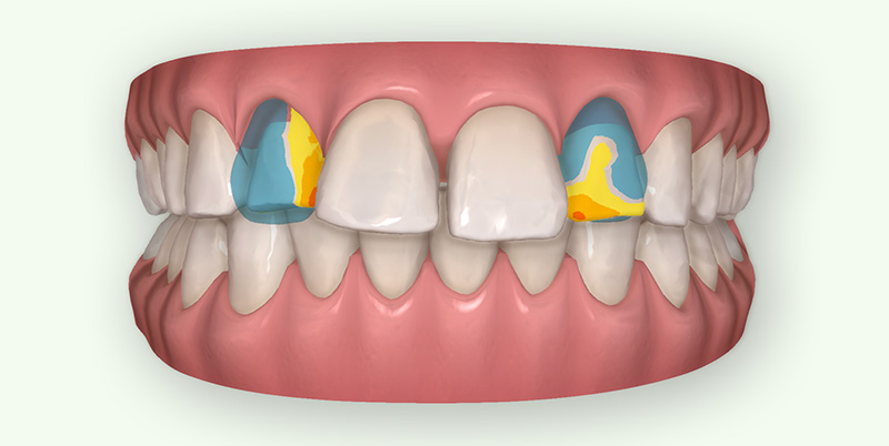 Simulation facettes avant Invisalign